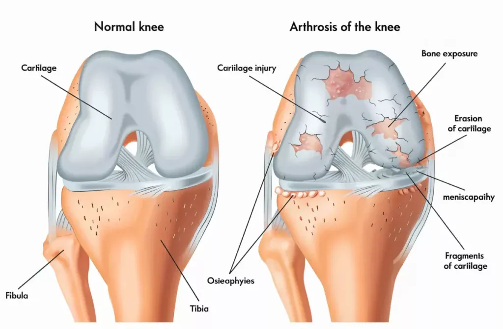 Difference Between Osteoarthritis and Osteoporosis