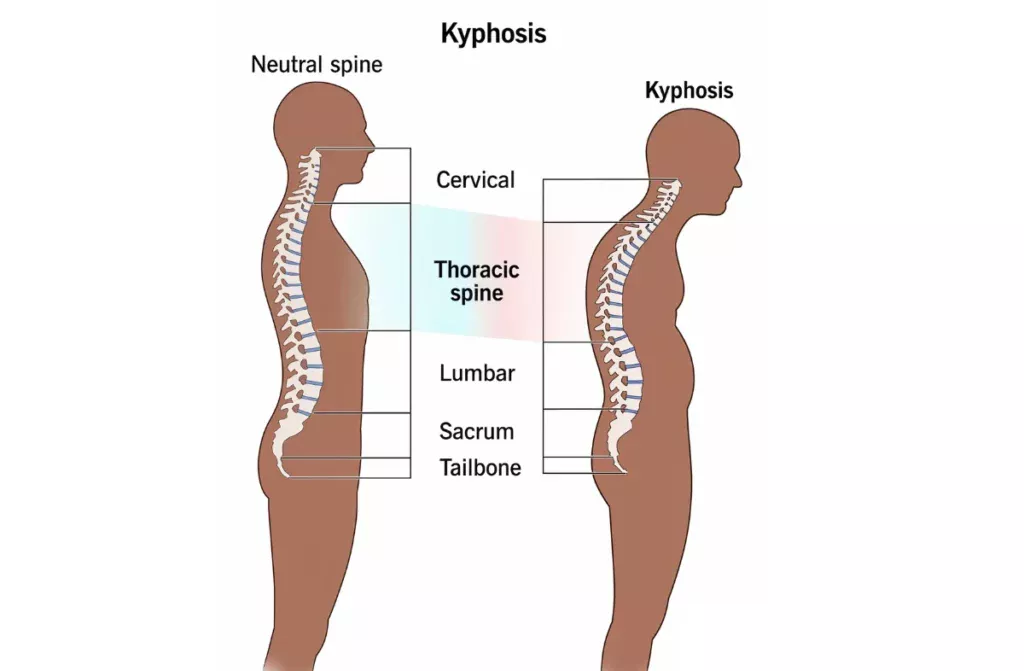 how to fix a curved spine