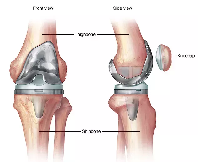 Best Knee Replacement Surgeon in India