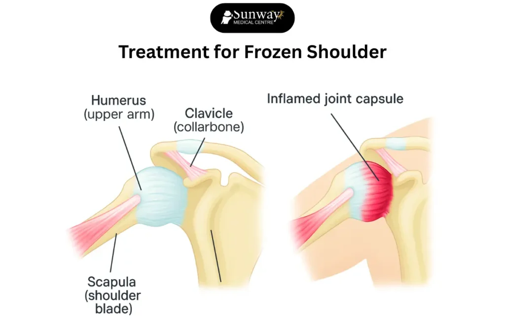 frozen shoulder treatment