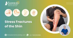 Stress fractures of the shin