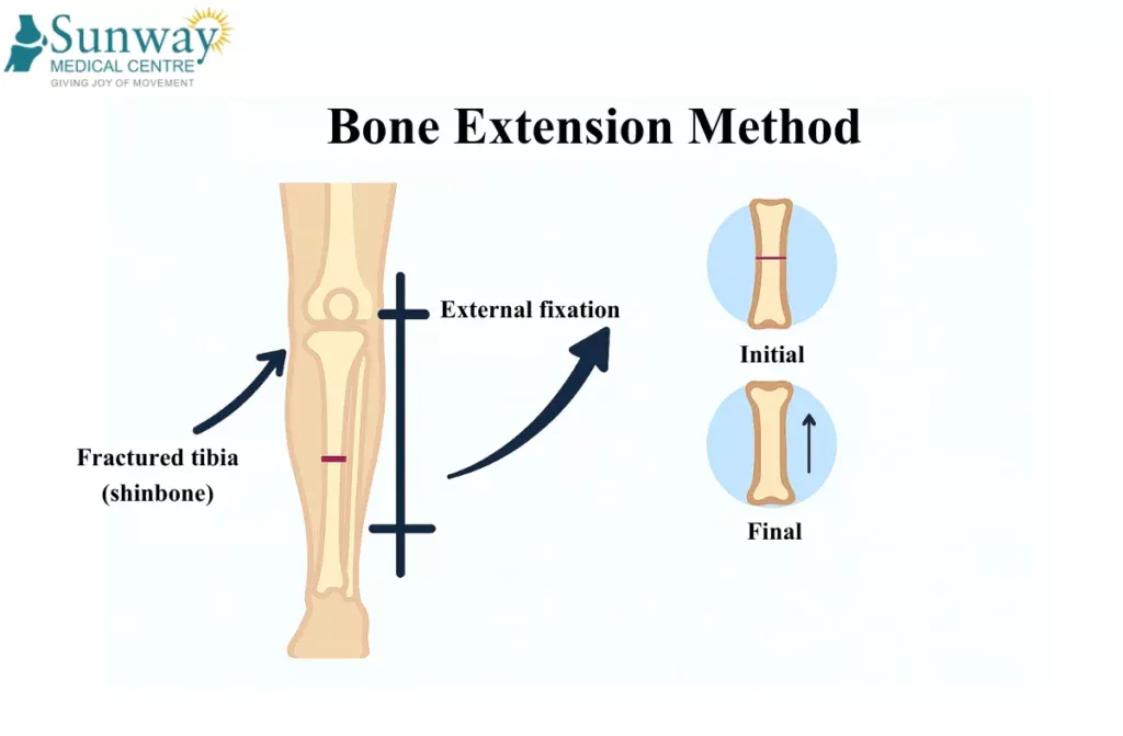 Limb Lengthening Surgery In Chennai