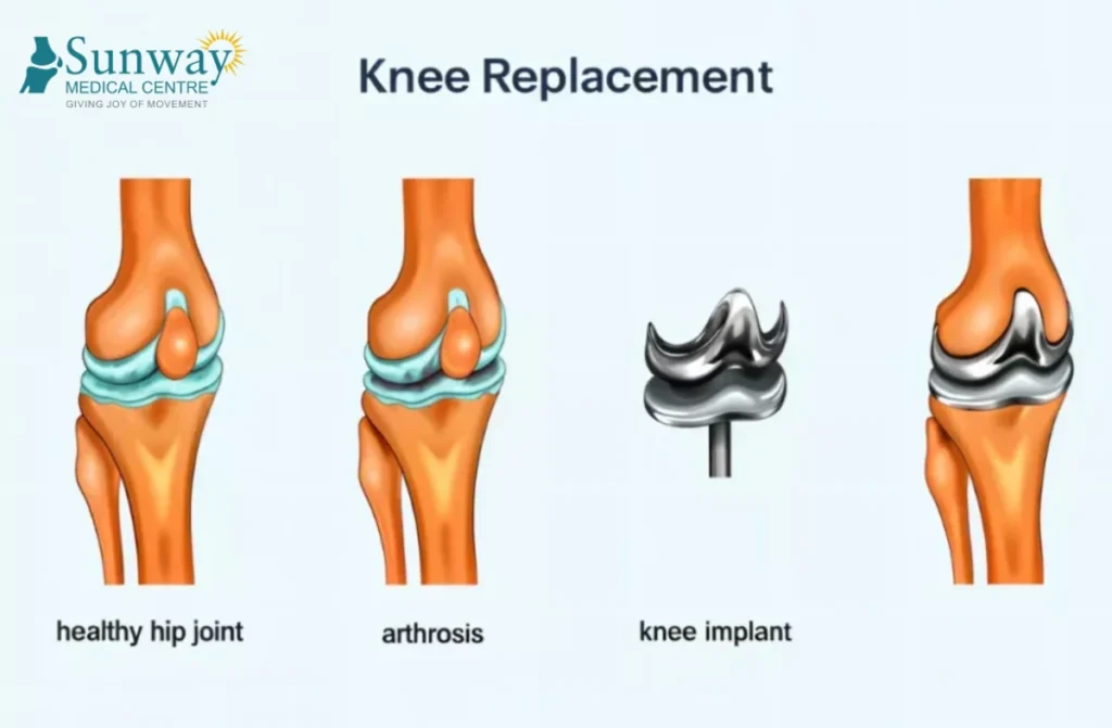 Knee Replacement Surgeons in Tamil Nadu
